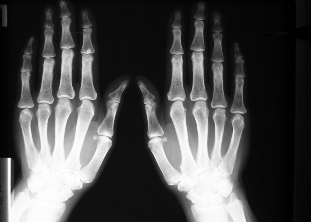 radiographie pour diagnostiquer la douleur dans les articulations des doigts
