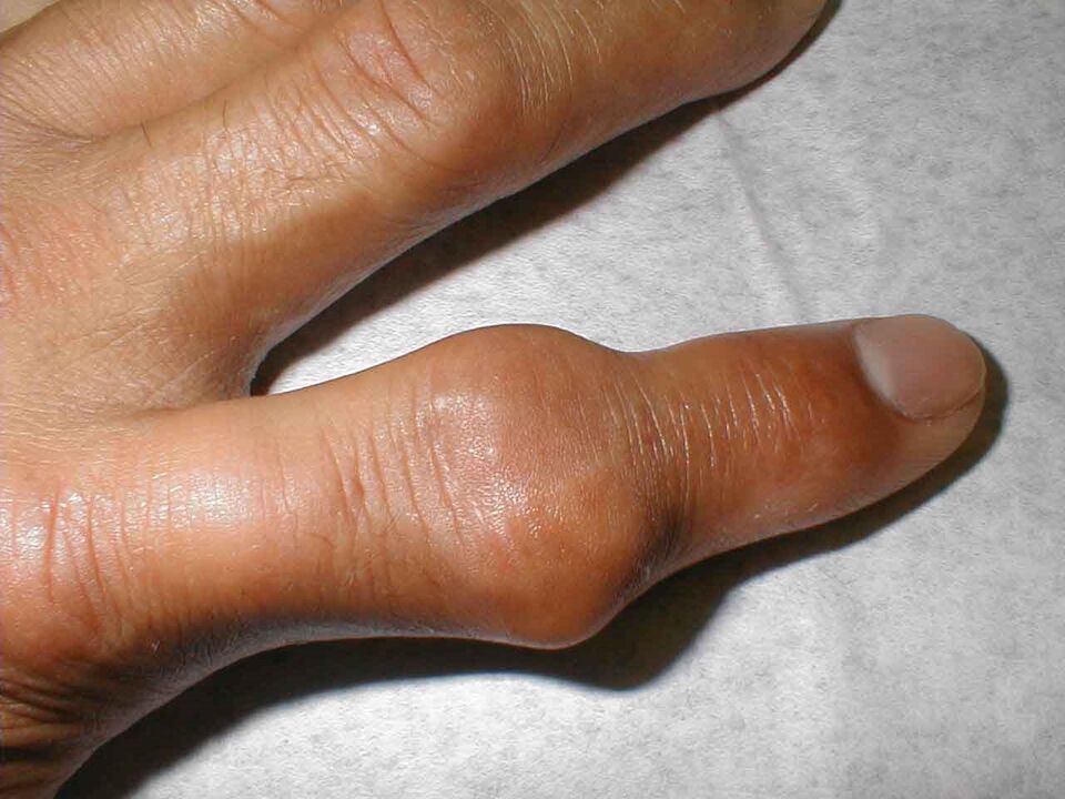 tophus dans l'articulation du doigt comme cause de douleur