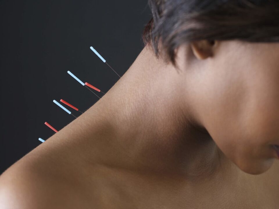L'acupuncture pour l'ostéochondrose cervicale élimine les processus inflammatoires